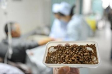肾中藏石20年手术取出4两“鹅蛋”