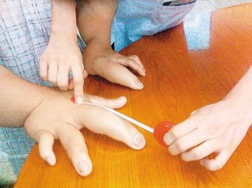 女子手指粗如幼童胳膊 称婚戒戴不上最遗憾