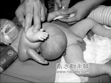 新生男婴长有四条腿两个生殖器