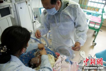四川罕见双头单体女婴病危 专家全力抢救