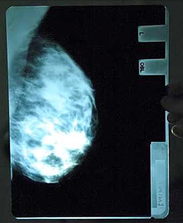 荷兰女星发布胸部X光照 澄清丰乳造假嫌疑