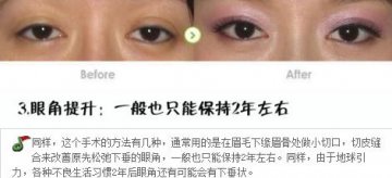 整形手术保质期大揭秘