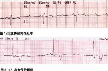 传导阻滞（下）