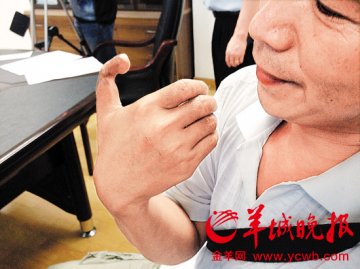 取下脚趾补手指致手脚残疾 男子状告医院获赔19万