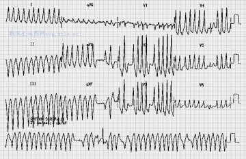 心房纤颤伴W-P-W wolff-Parkinson-White syndrome with atrial fibrillation