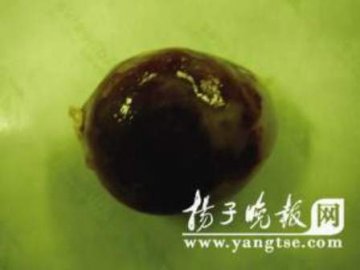 老太心脏长鸡蛋大肿瘤 色彩鲜艳仿佛雨花石