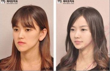 31个惊人韩国整容案例
