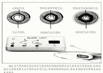 支气管热成形术填补重度持续哮喘治疗空白