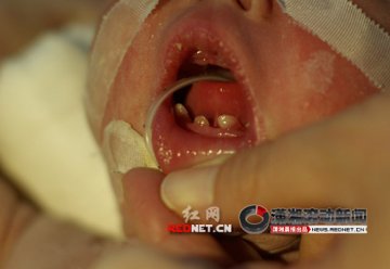 婴儿出生时长有4颗牙齿 专家称情况罕见