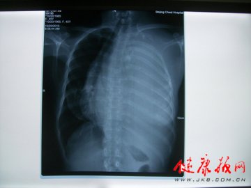北京胸科医院为45岁患者成功切除8斤多的神经纤维瘤