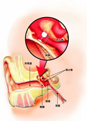 耳朵里钓进一只