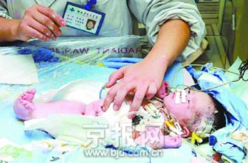 美人鱼婴儿初步手术完毕 几天后可进食