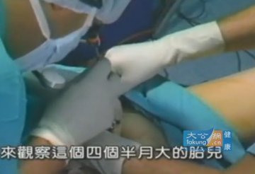 实拍堕胎手术全过程 呼吁珍惜生命