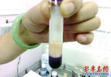 孕妇进补过量补出牛奶血 血中过半是脂肪