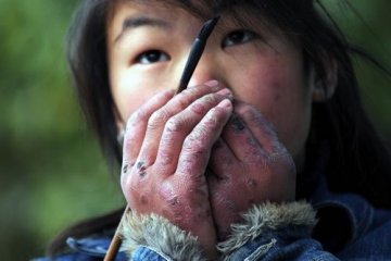 “倒春寒”小心冻疮发生