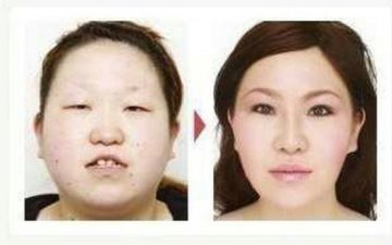 日本整形医院惊悚整容对比照大曝光