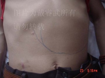 巨大胰腺假性囊肿1例