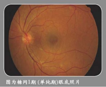 糖尿病眼底检查--你的视力你做主