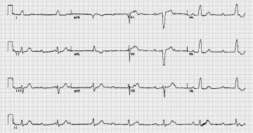 完全性房室传导阻滞Complete Heart Block
