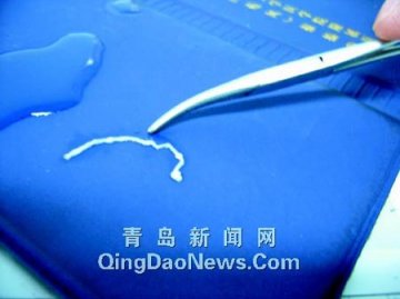 女孩常吃田螺青蛙 脑中长出四厘米活虫