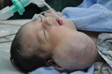 5天“双头”男婴在孙逸仙纪念医院成功获救