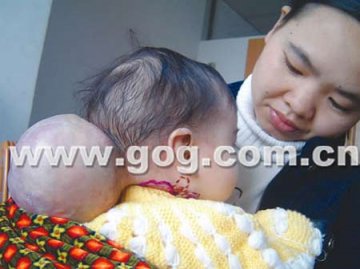 半岁婴儿脑后长出饭碗大小包块