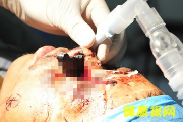 临床快递：15厘米摩托车手柄从眼眶插入车祸男子后颈