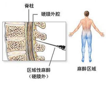 女性剖腹产手术全过程图解