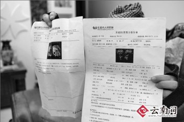 子宫肌瘤变双胞胎 医院两次产检结果不同遭质疑