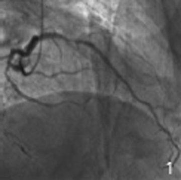 Sprinter球囊在慢性完全闭塞病变中的应用
