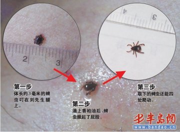 青岛又有市民被蜱虫咬伤 记者目击治疗全过程