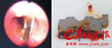 女子与家人吵架吞刀片 细心医生巧手取出