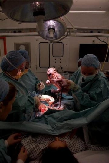 剖腹产宝宝出生瞬间