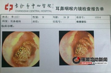 长沙一女子耳道藏活蜘蛛 医院检查被吓哭