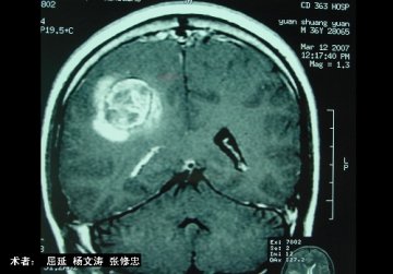 脑海绵状血管瘤切除术