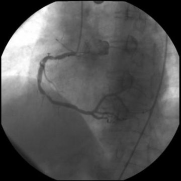 AMI直接PCI