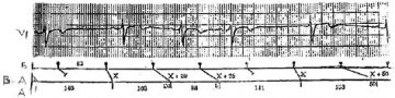 窦房阻滞