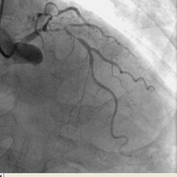 Step Standard crush stent治疗左主干分叉病变