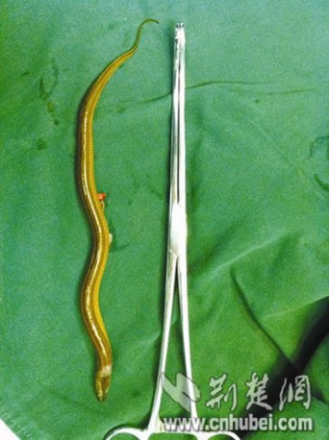 男子听信美容偏方和鱼共浴 遭黄鳝钻尿道游进膀胱