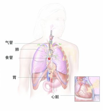 鱼刺一头扎进了心脏主动脉