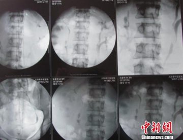 湖北一男子长罕见“四颗肾” 称“并无压力”