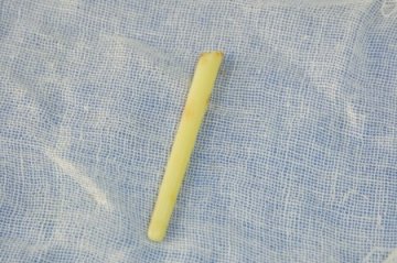 患者6厘米断筷藏眼内11年未发现 手术后取出