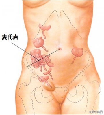 信息图：阑尾位置变异