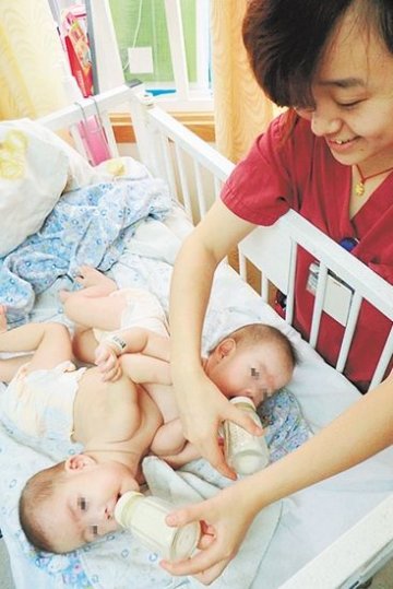 连体姐妹接受6小时手术成功分离