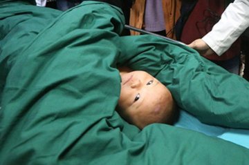 体内含针危害大 如何快速取出身体里的针