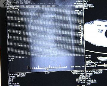 男孩内脏位置左右对调 心脏手术难度极大