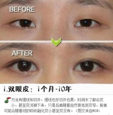 整形手术保质期大揭秘