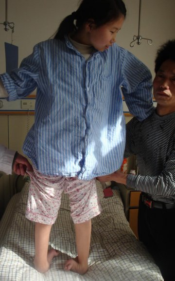 5岁花季少女治愈“马蹄足”家长愁容变笑容