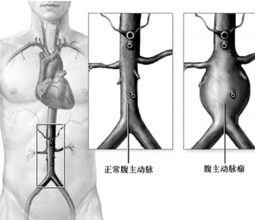 腹主动脉瘤 难辨的凶手