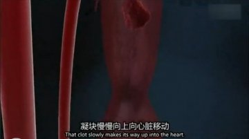 医学解读：男子腿绑香肠冒充阳物为何丧命